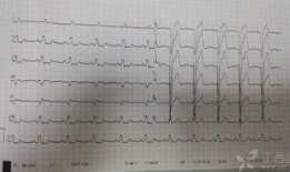 齐鲁医院心电图吃瓜,吃瓜群众的心脏健康指南