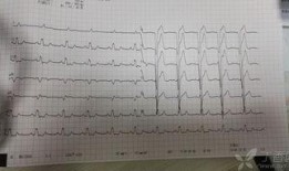 齐鲁医院心电图吃瓜,吃瓜群众的心脏健康指南